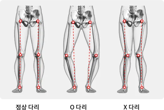 AI 자세분석 알고리즘으로 O다리와 X다리, 백니 상태를 비교 분석한 이미지