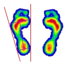 발 아치 유형에 따른 발바닥 압력 분포를 시각화한 족문분석 이미지