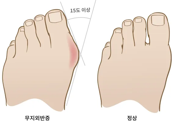 무지외반증의 정상 발과 변형된 발 형태를 비교한 설명 이미지